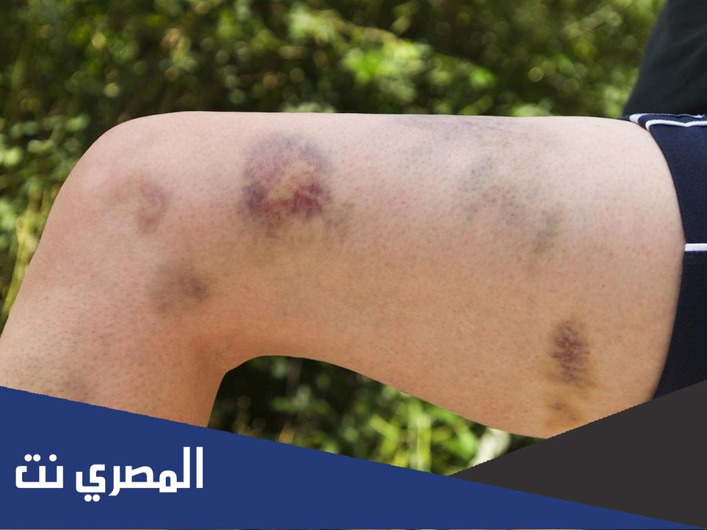 ما هي أعراض الجلطة في الساق