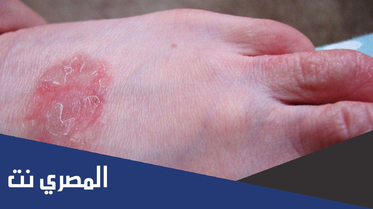 ما هي أعراض الحساسية الغذائية