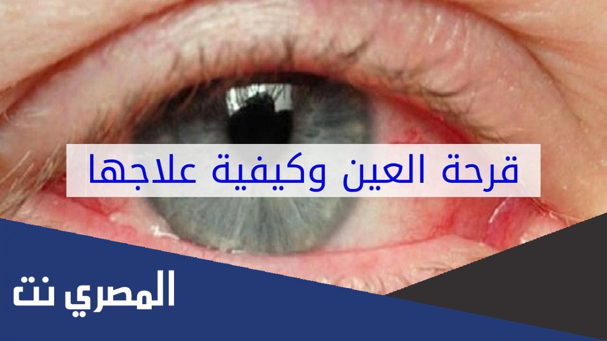 ما هي قرحة العين وطرق الوقاية منها ؟