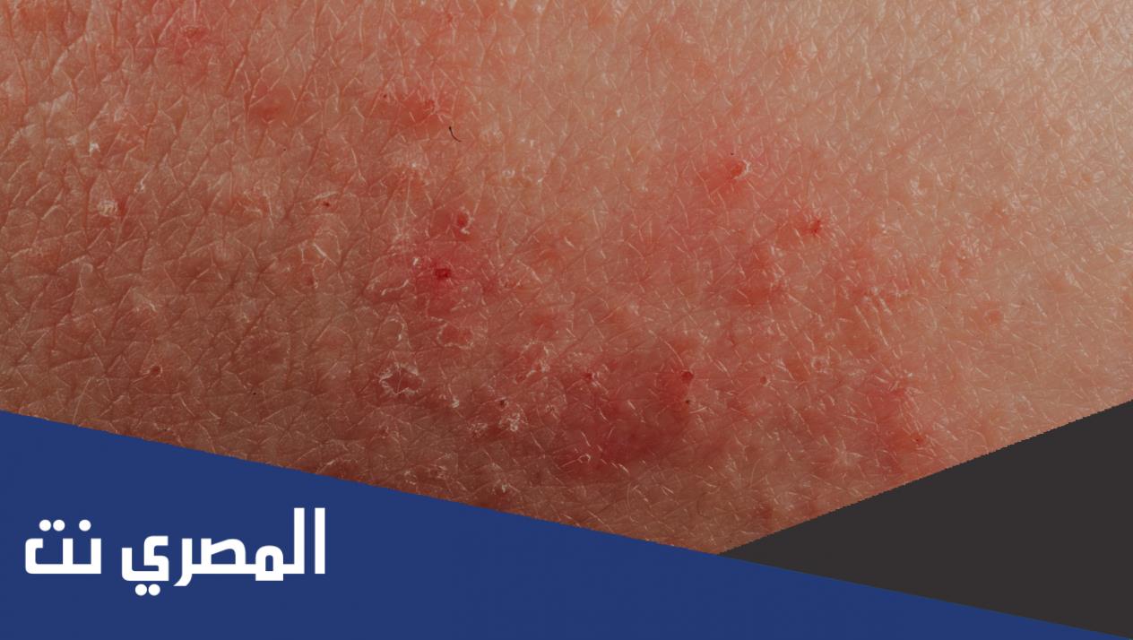 ماهو مرض النخالة الوردية هل هو معدي