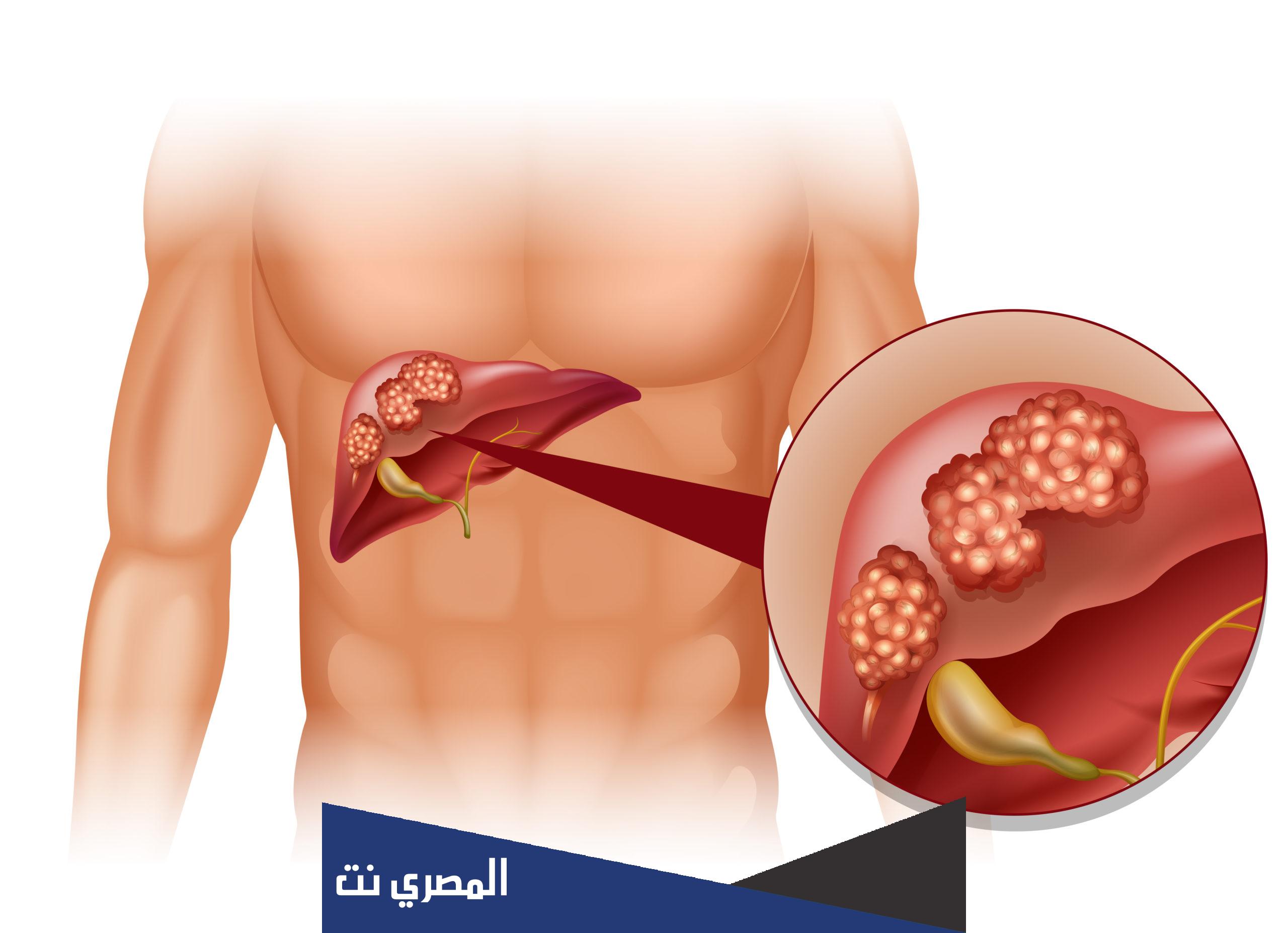 مراحل سرطان الكبد في الجسم