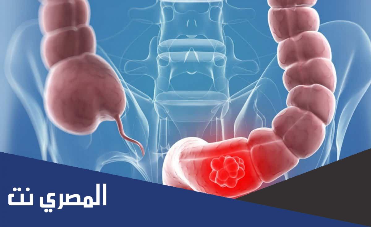 هل القولون له علاج نهائي