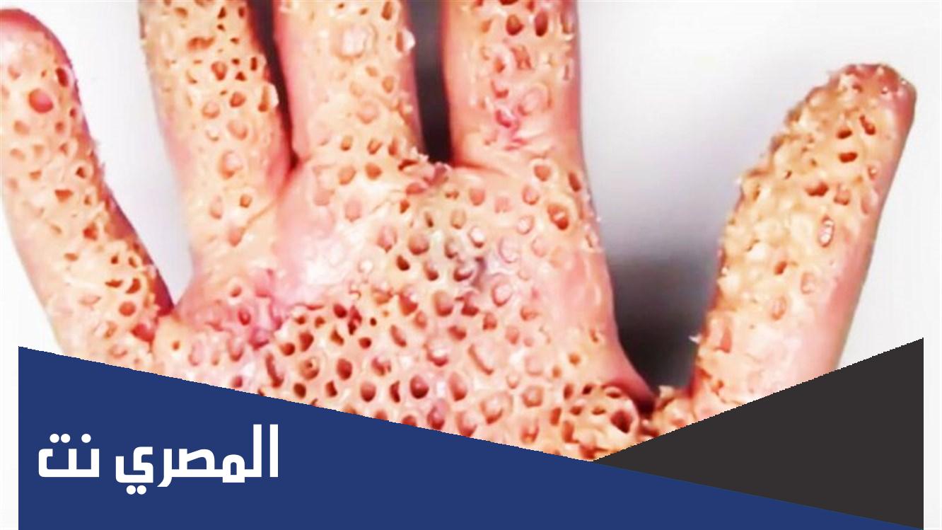 ما هو رهاب النخاريب