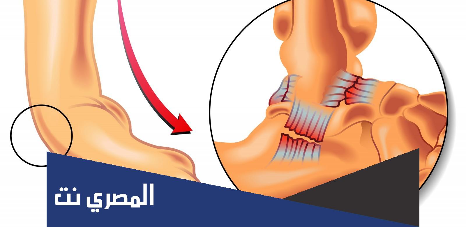 ادوية علاج تمزق اربطة الكاحل 2022