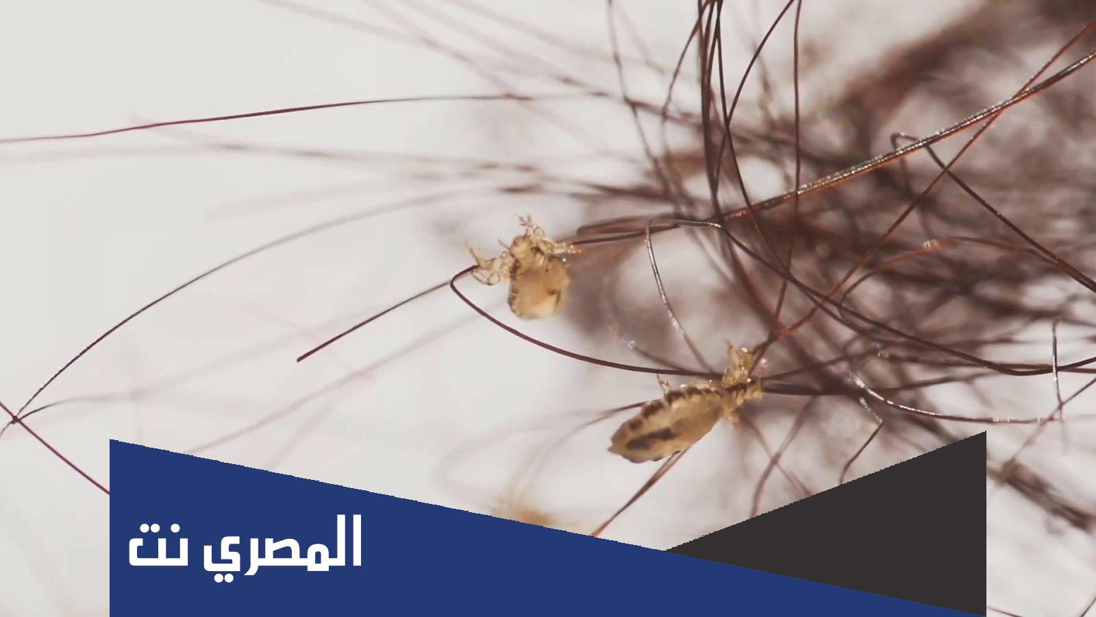 تفسير حلم القمل في الشعر للمتزوجة