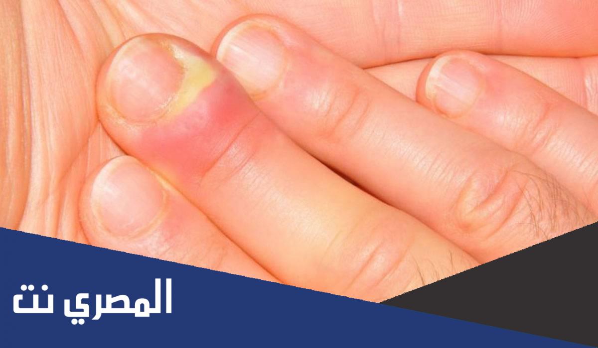 علاج تورم الاصابع بسبب ضربه وكيفية الوقاية من تورم