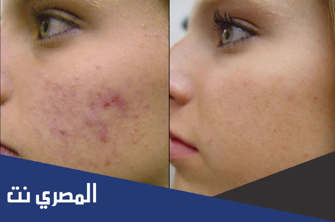 كريم لازالة اثار حب الشباب في اسبوع بالصور والأسعار