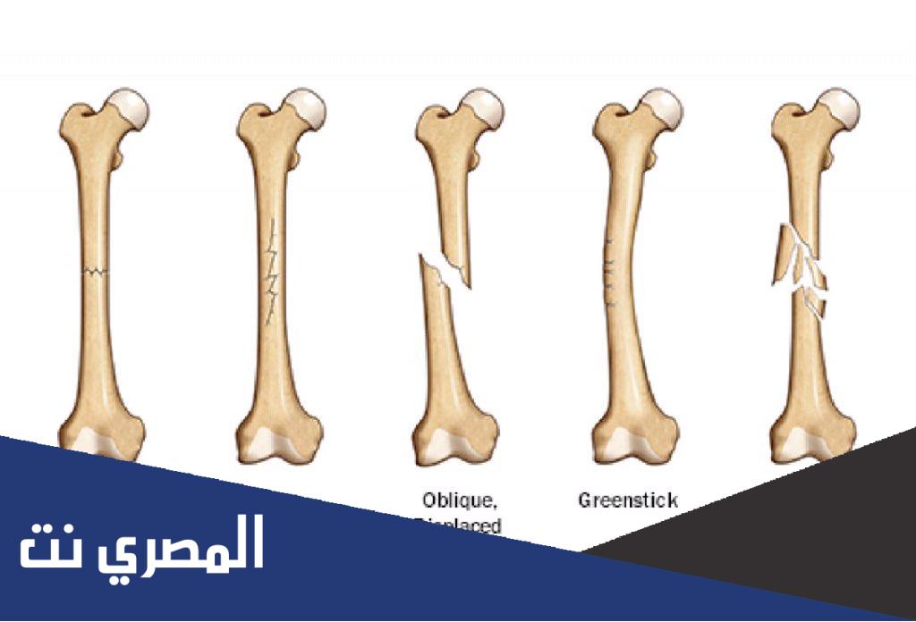 كم مدة جبيرة مشط القدم؟
