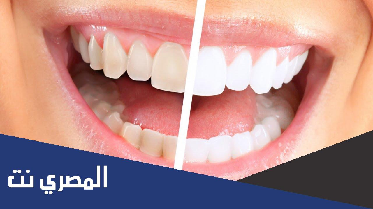 كيف ازيل تسوس الاسنان في المنزل