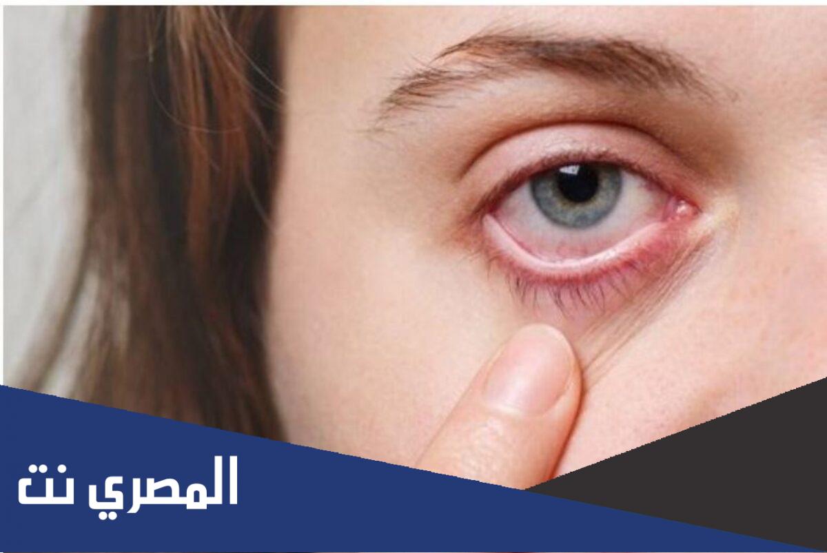 ما سبب وجود ضباب على العين فجأة وطرق الوقاية من تكوّن