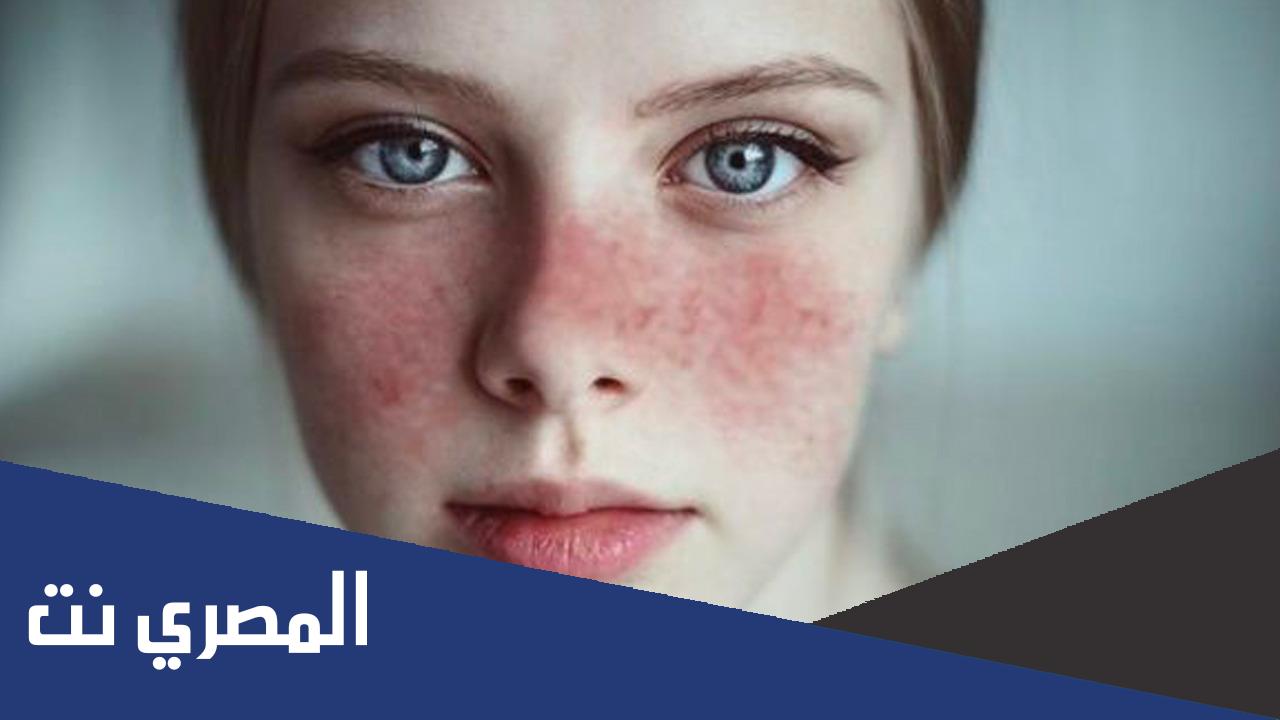 هل مرض الذئبة الحمراء مميت