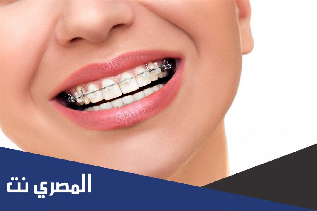 متى تبدأ الأسنان تتحرك بعد التقويم
