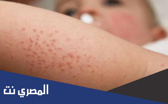 اسباب حساسية الجلد المفاجئة بدون حكة