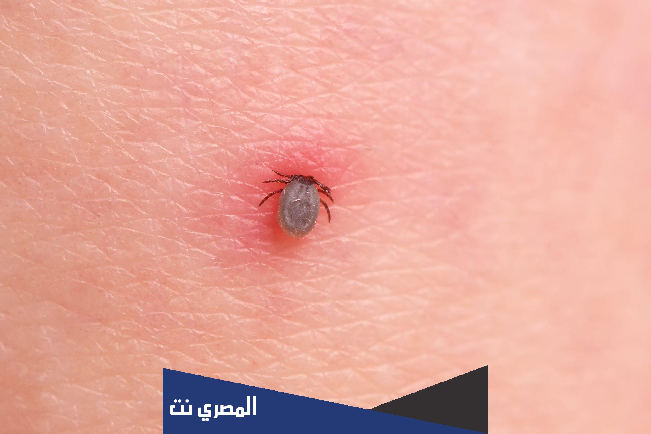 ما هو القراد عند الانسان