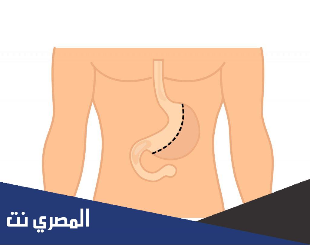 ما هي عملية التكميم وكم تكلفتها