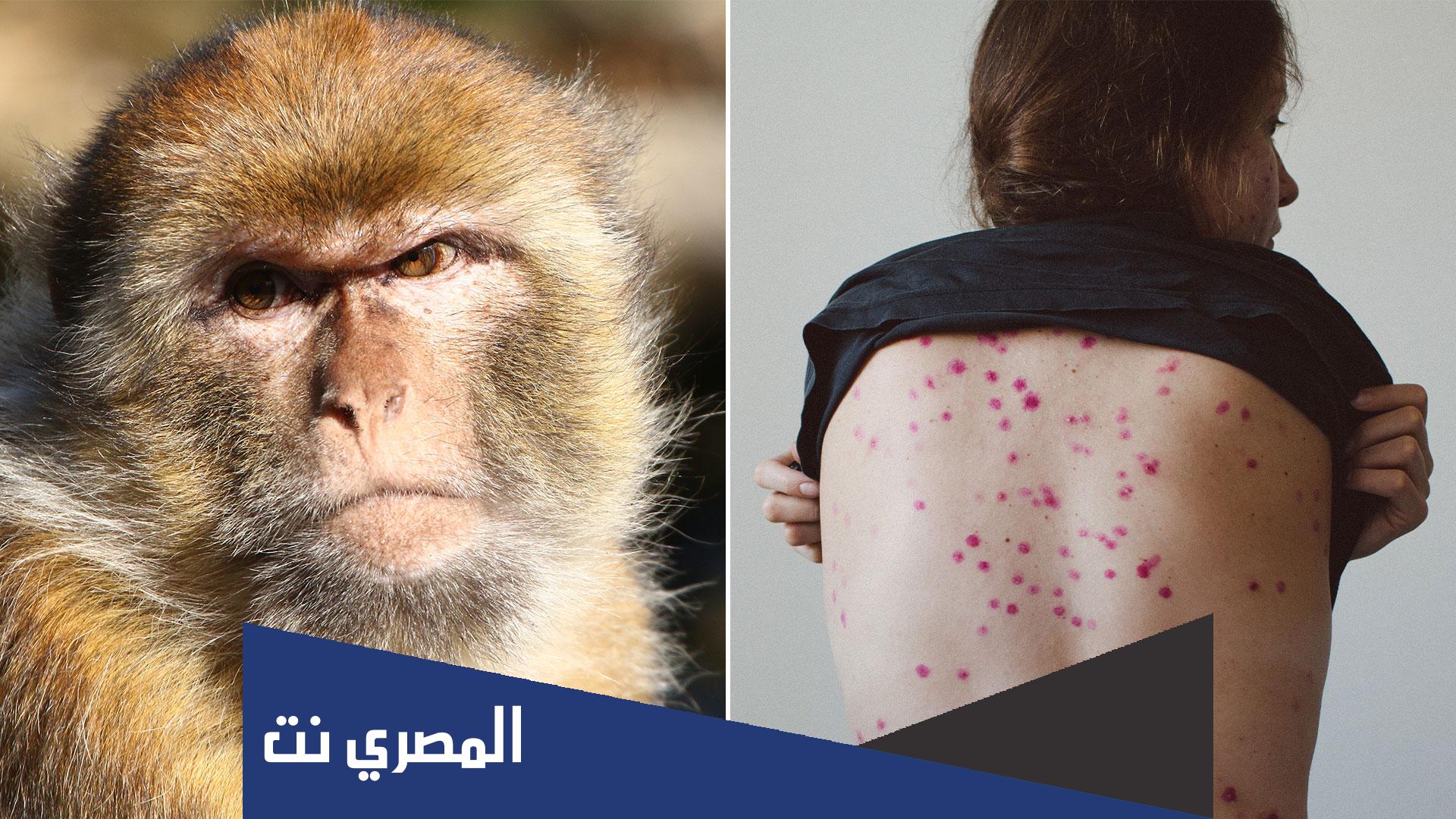 لماذا سمي جدري القرود بهذا الاسم