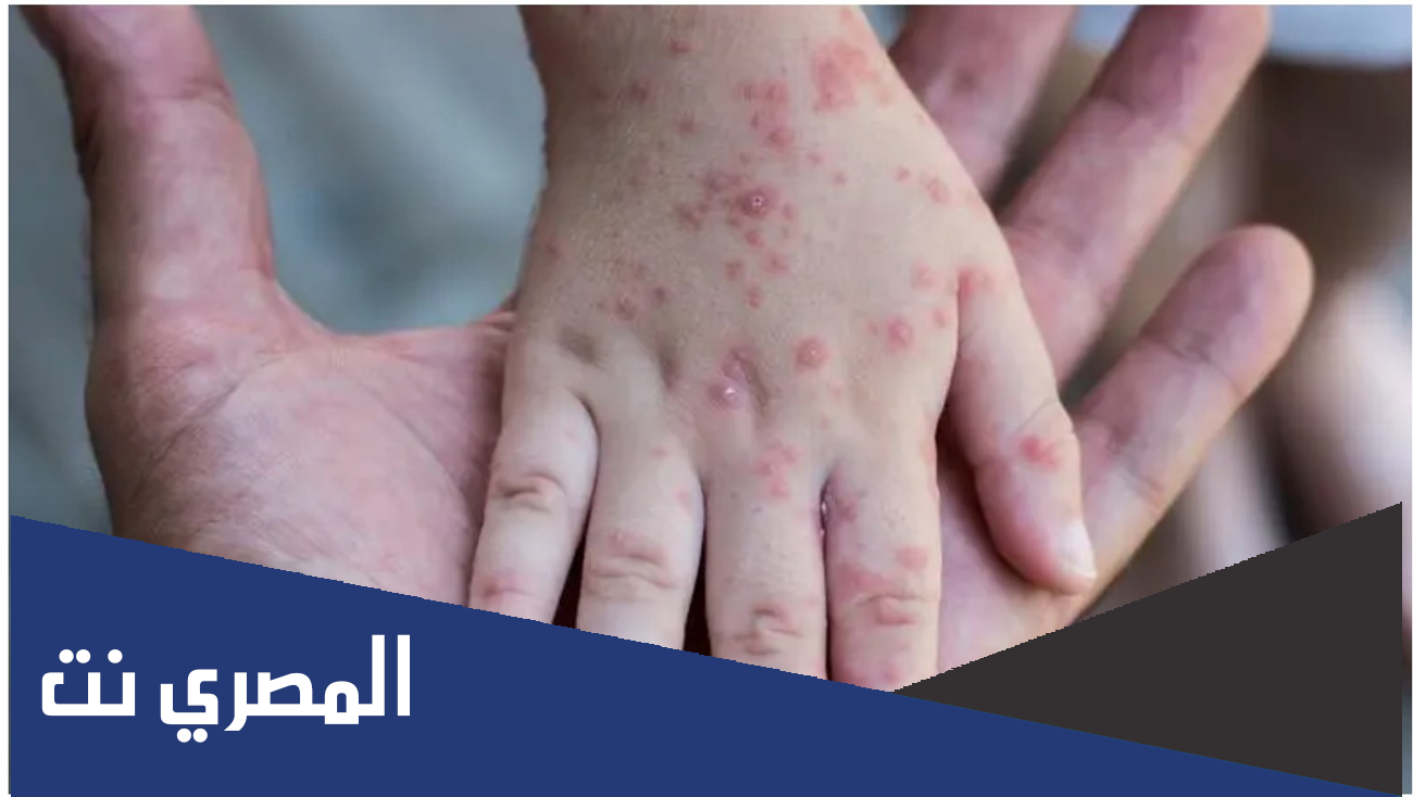 جدري القرود ويكيبيديا