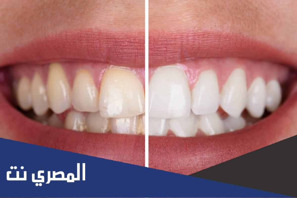 ابتسامة هوليود في السعودية | التكلفة والطرق وأكثر