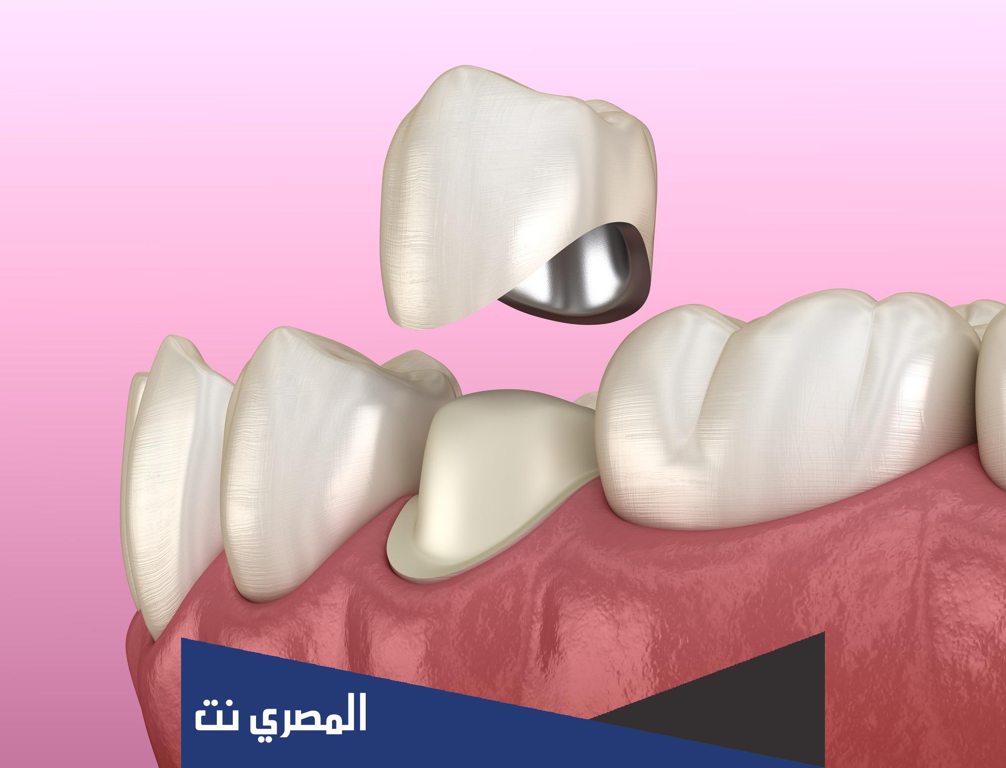 اسنان زيركون الأنواع والمميزات والعيوب والتكلفة