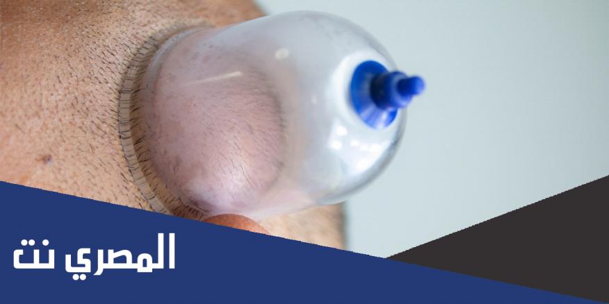 الحجامة في الرأس