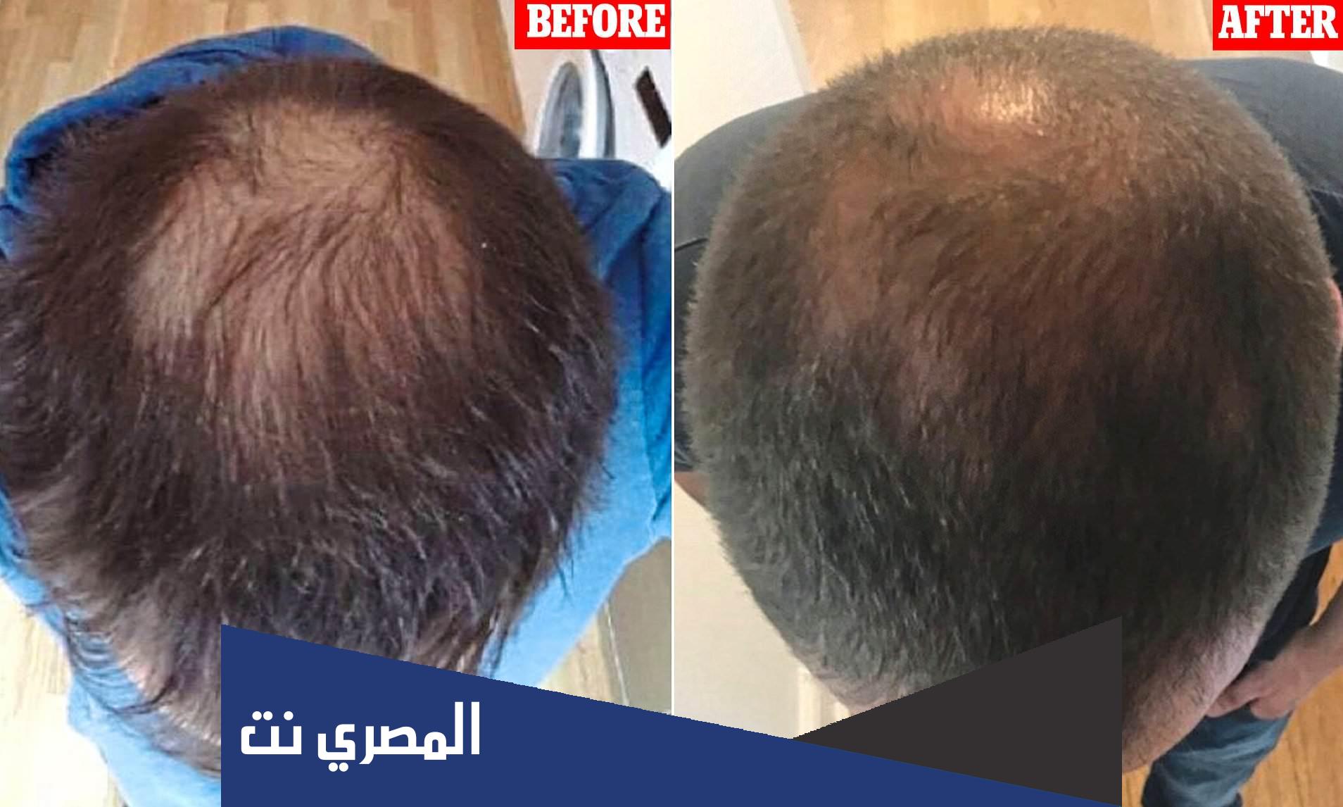 الخلايا الجذعية للشعر | كيفية علاج تساقط الشعر بالخلايا