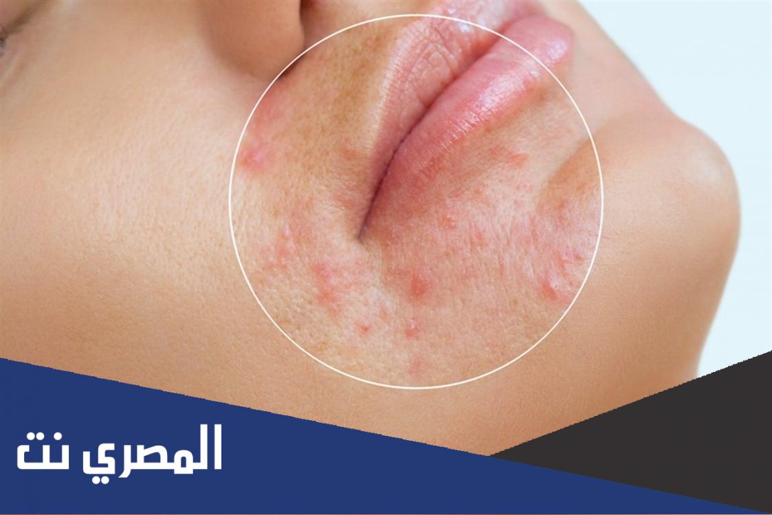 الفرق بين حمو النيل والحساسية عند الكبار