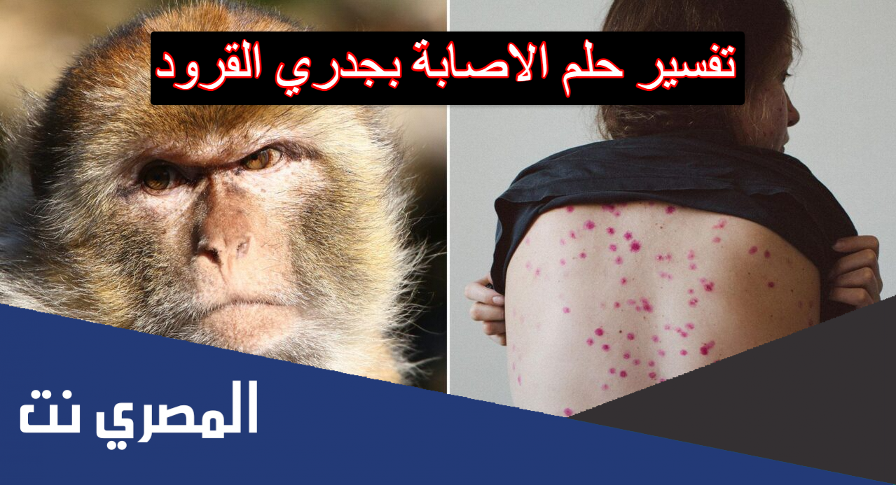 تفسير حلم الاصابة بجدري القرود