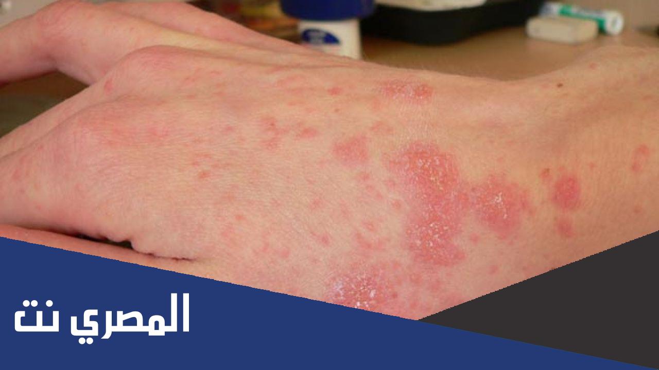 تفسير حلم الاصابة بمرض الايدز