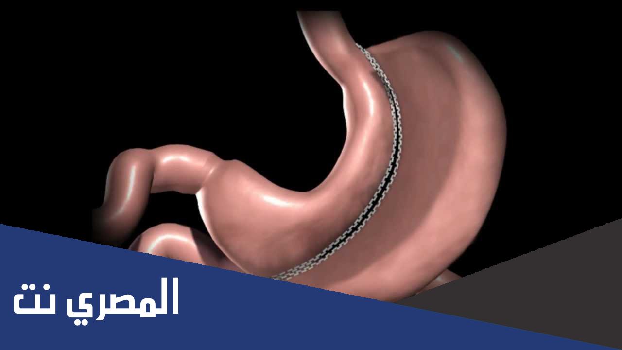 تكلفة عملية تكميم المعدة في فلسطين والاردن