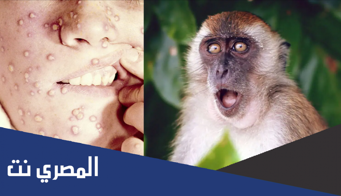 حقيقة تفشي مرض جدري القرود بين المثليين