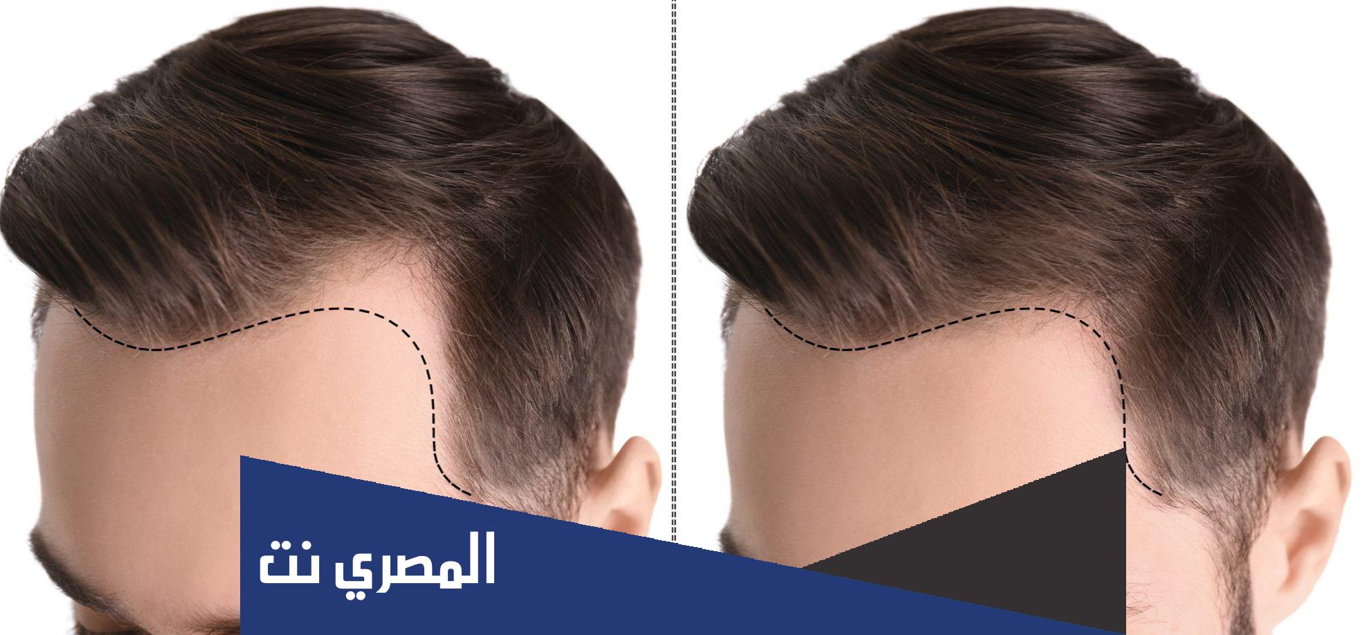 زراعة الشعر في تركيا تجربتي