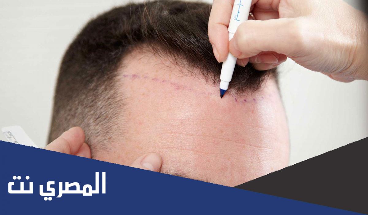 كم تكلفة زراعة الشعر في تركيا