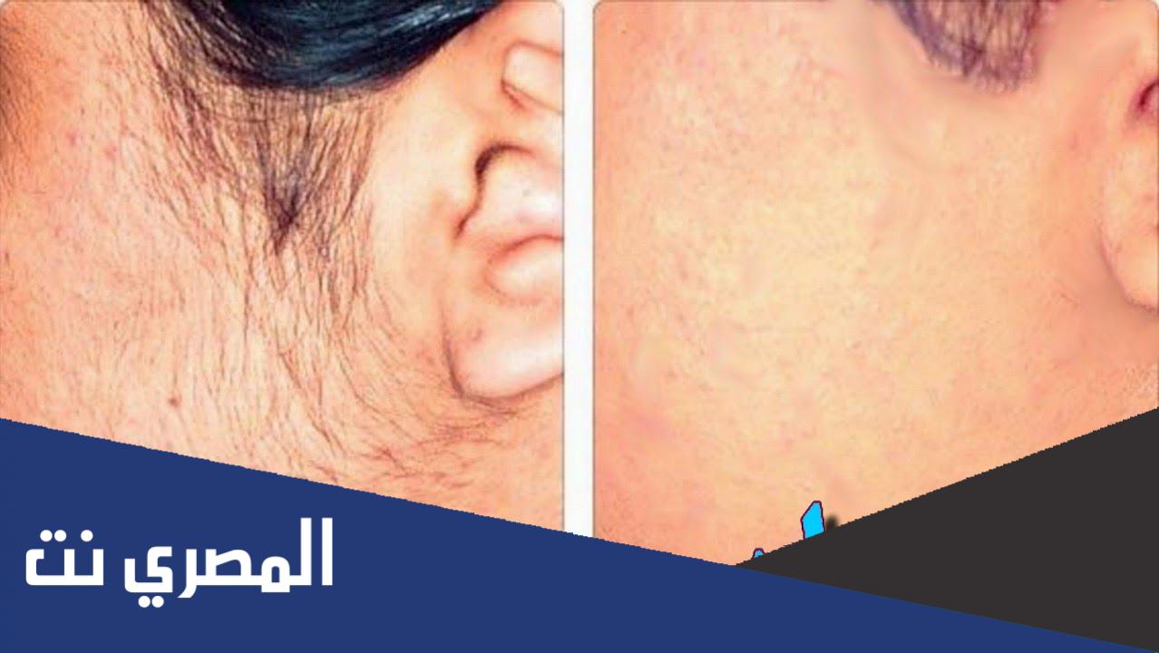 كيف اشيل شعر وجهي
