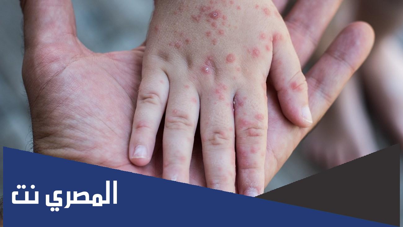 ما الفرق بين جدري القرود وفيروس كورونا