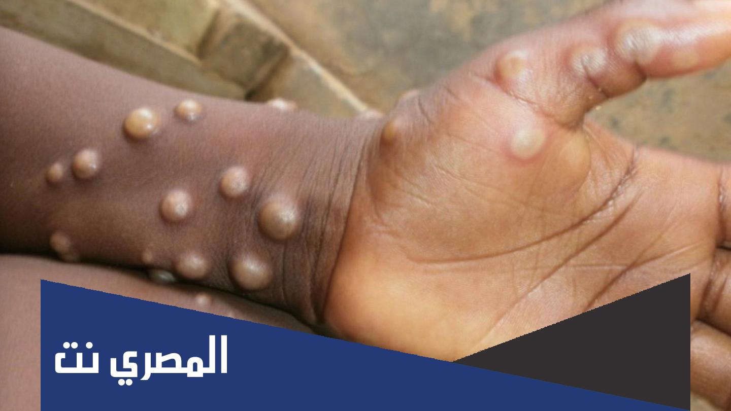ما هو جدري القرود المنتشر في افريقيا
