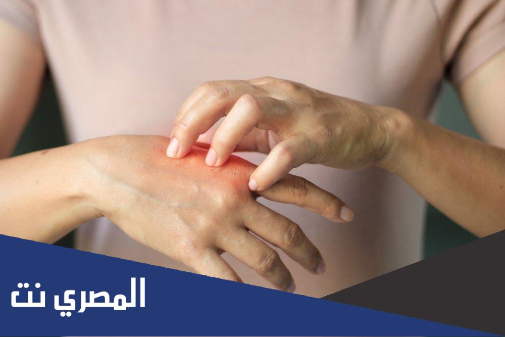 أفضل كريم لعلاج الإكزيما نهائياً