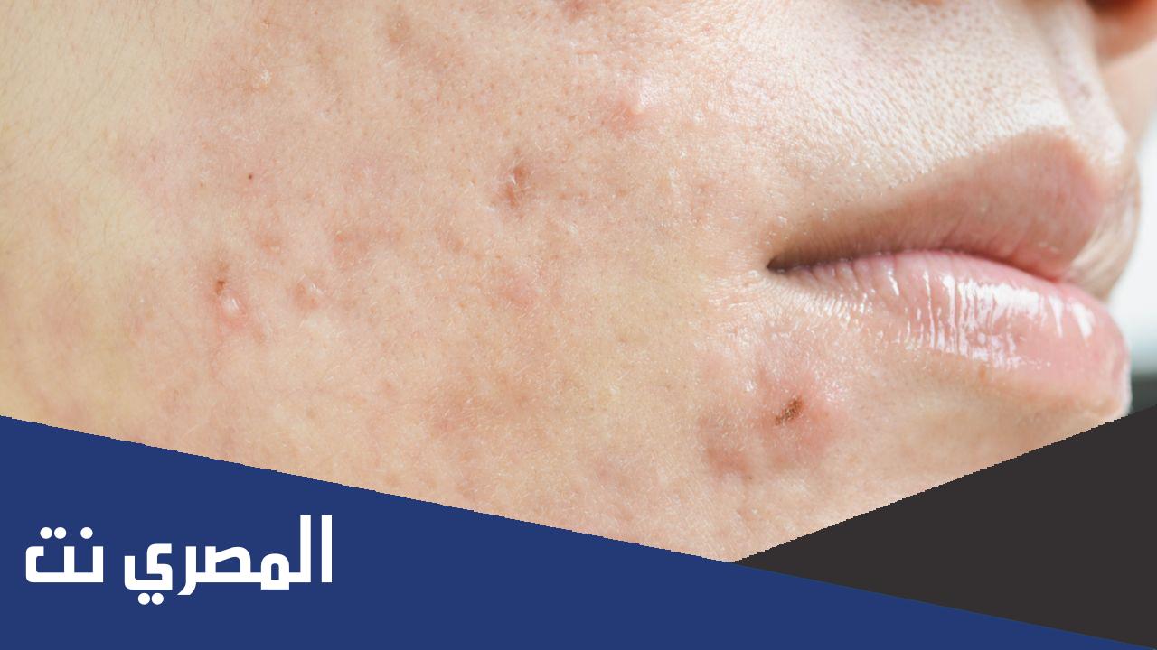 إزالة ندبات الوجه | التكلفة والنتائج وأكثر 2022