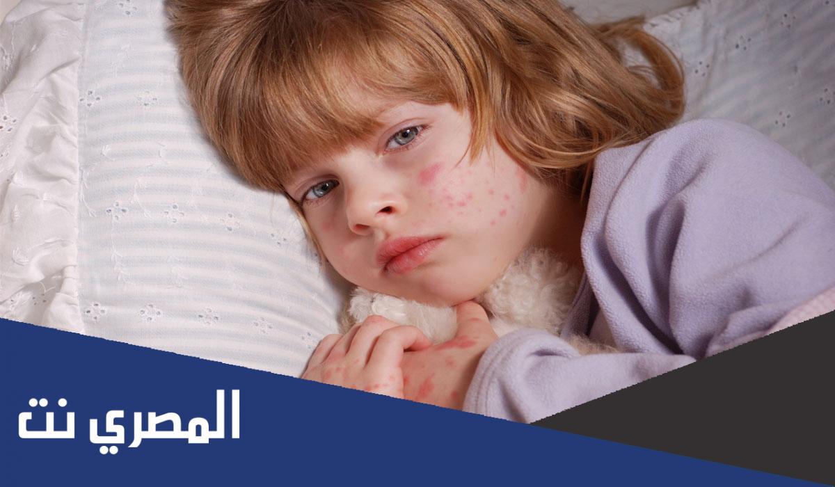 اسم افضل مرهم حساسية للاطفال من الصيدلية