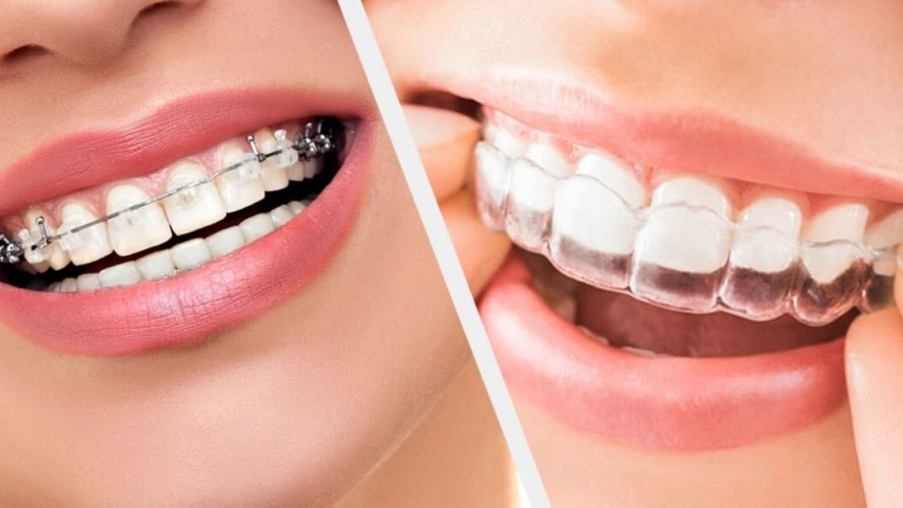افضل أنواع تقويم الاسنان | المميزات والعيوب وأكثر