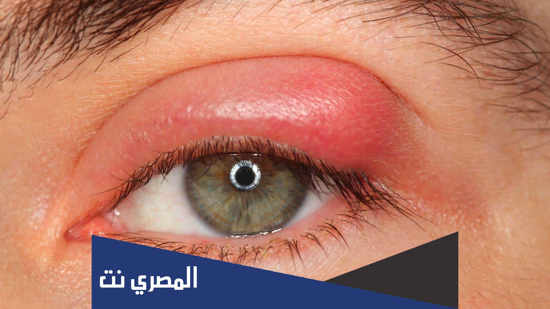 افضل مرهم لعلاج الكيس الدهني