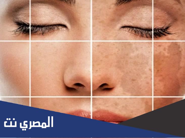 تجربتي مع تصبغات الوجه