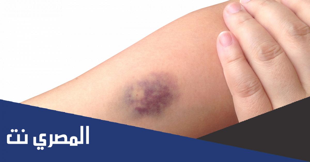 ظهور بقع زرقاء في الجسم عند النساء بدون سبب. لماذا