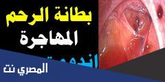 هل بطانة الرحم المهاجرة تمنع الحمل ؟