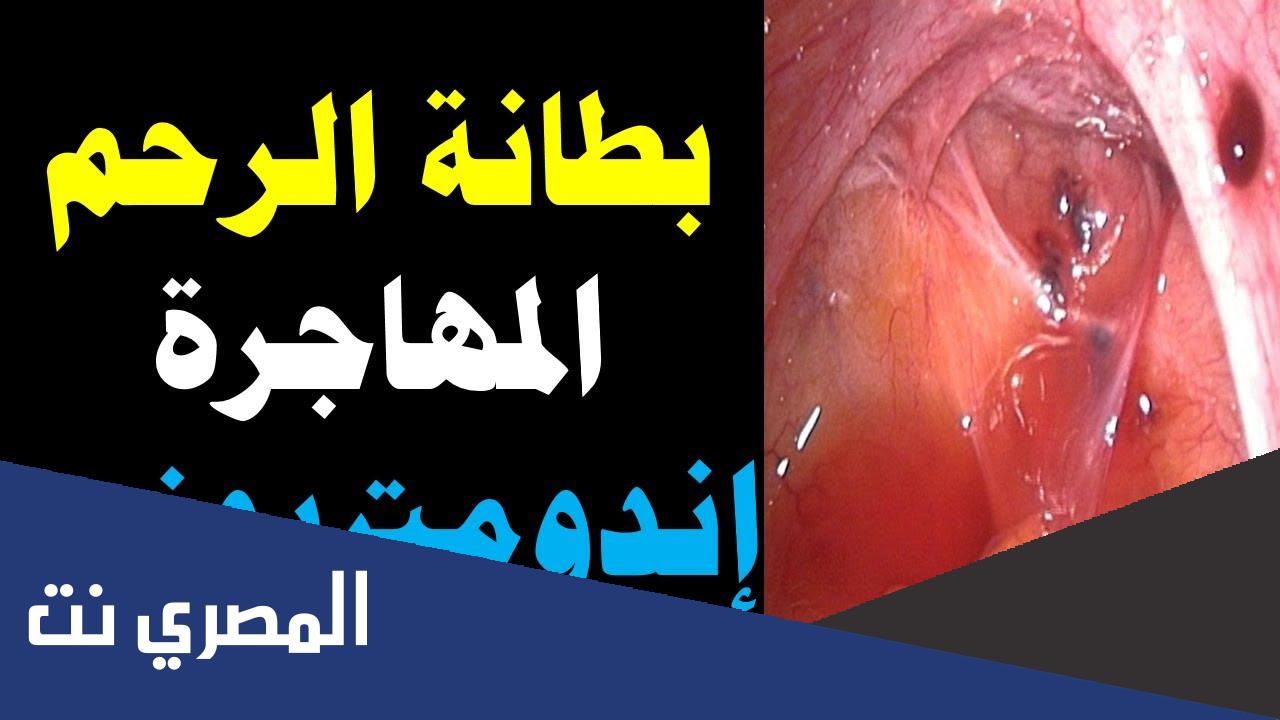 هل بطانة الرحم المهاجرة تمنع الحمل ؟