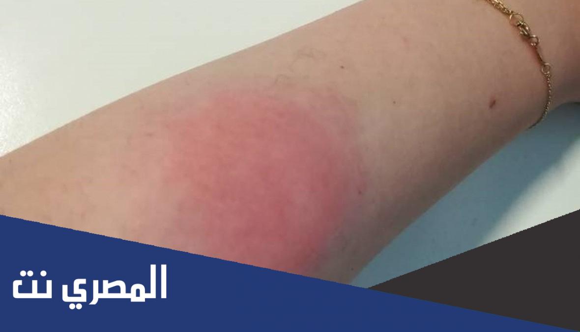 solerat لماذا يستخدم