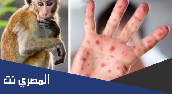 ما هي الدول التي اعلنت فيها حالة الطوارئ بسبب جدري القرود