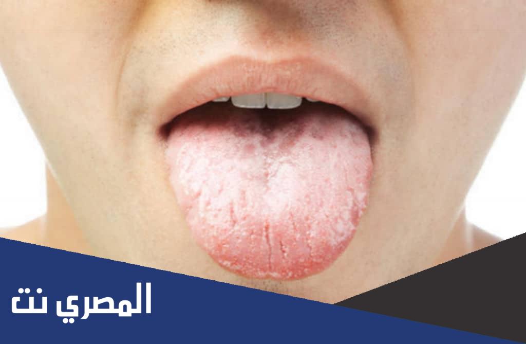 على ماذا يدل جفاف الفم عند الاستيقاظ