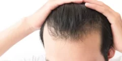 زراعة الشعر في السعودية معلومات مفصلة
