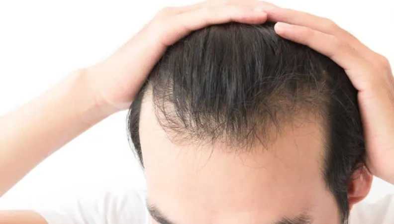 زراعة الشعر في السعودية معلومات مفصلة