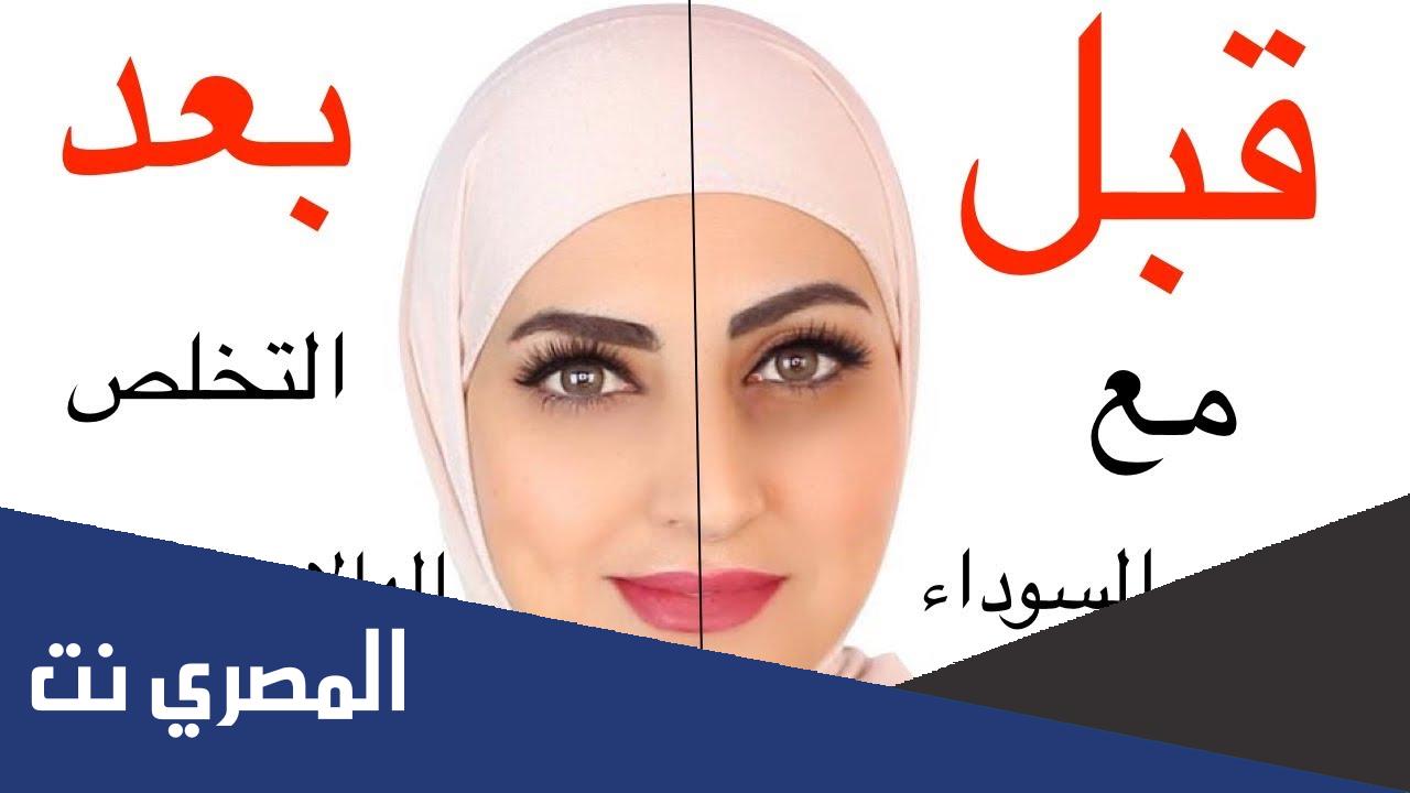 كيف اتخلص من الهالات السوداء